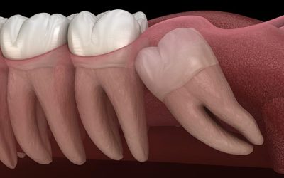 Operasi Gigi Bungsu Terpercaya dan Berkualitas