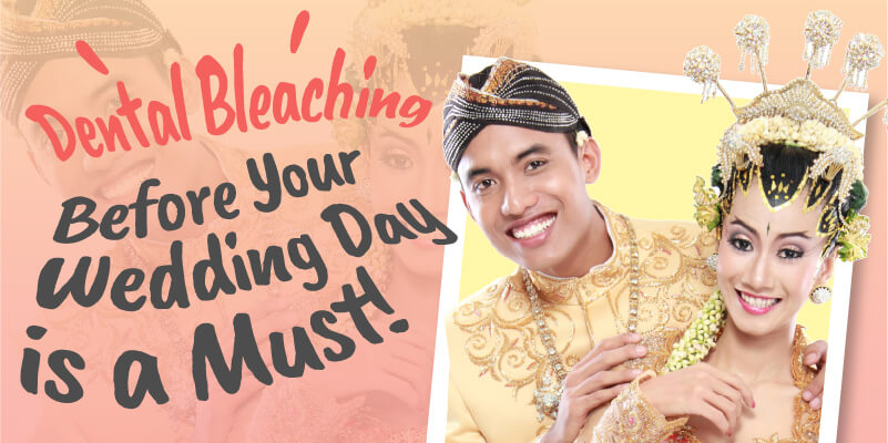 Bleaching Gigi Sebelum Pernikahan