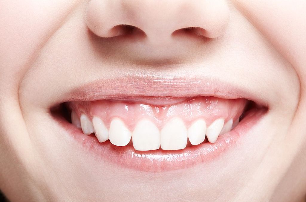 Mengenal Gummy Smile dan Perawatannya