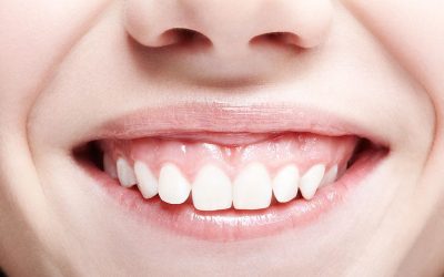 Mengenal Gummy Smile dan Perawatannya
