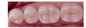 Mahkota Gigi Tiruan Zirconia