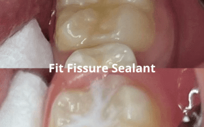 Dental Sealant: “Perisai Super” untuk Mencegah Gigi Berlubang
