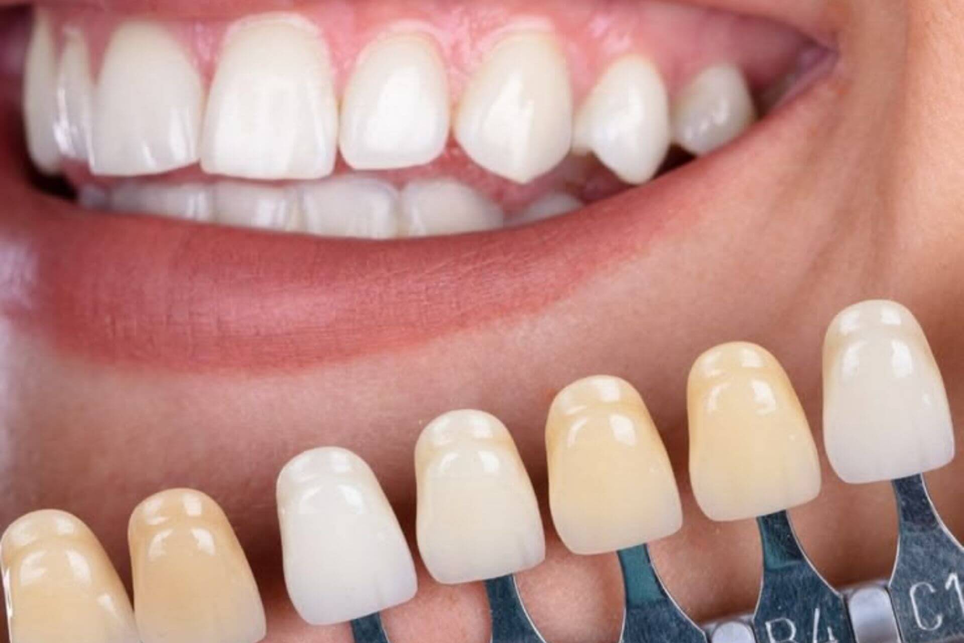 Proses pembersihan dan perawatan bleaching gigi aman di klinik gigi Dentistime Bekasi