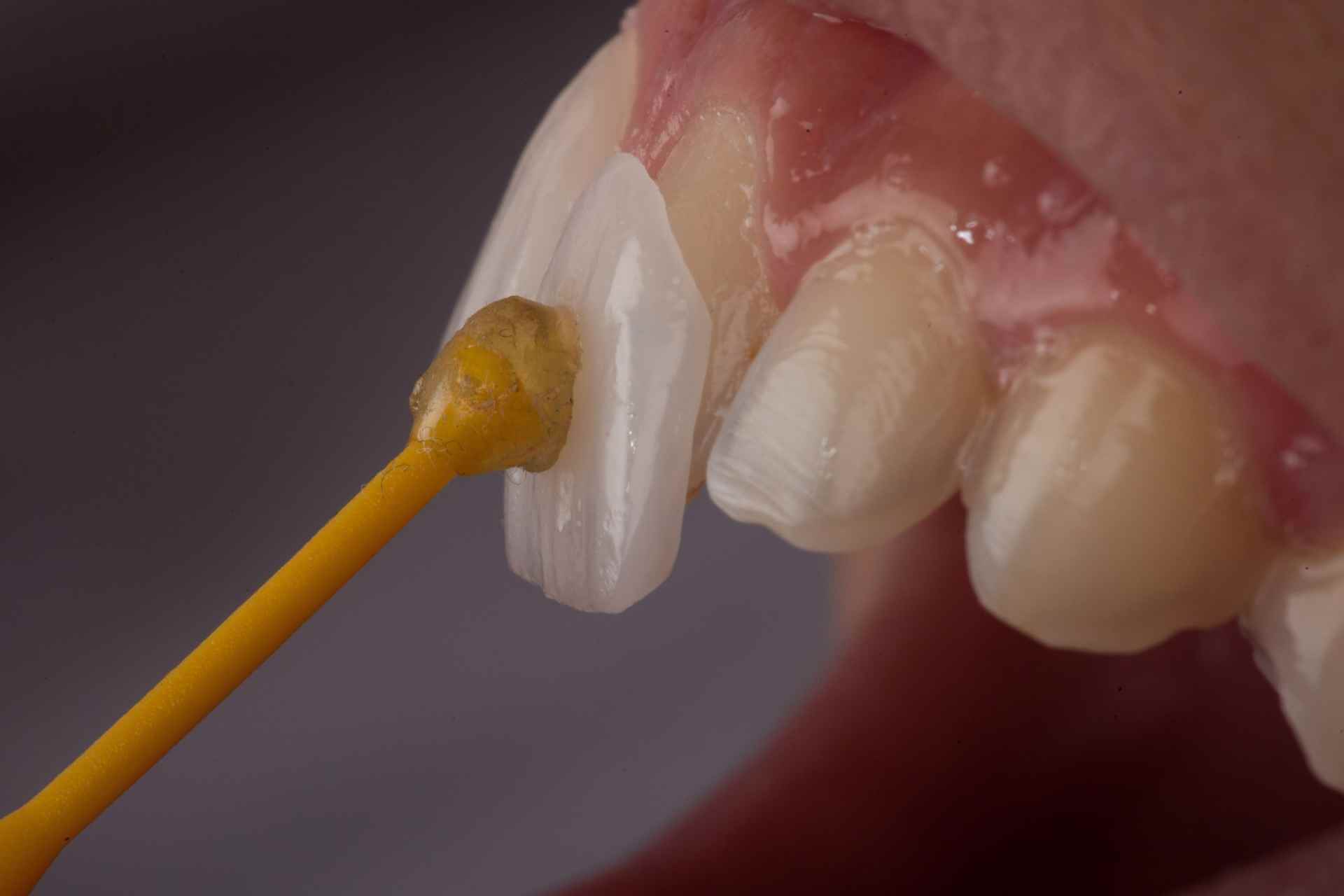 Proses perawatan dental veneer untuk estetik senyum cemerlang di Dentistime