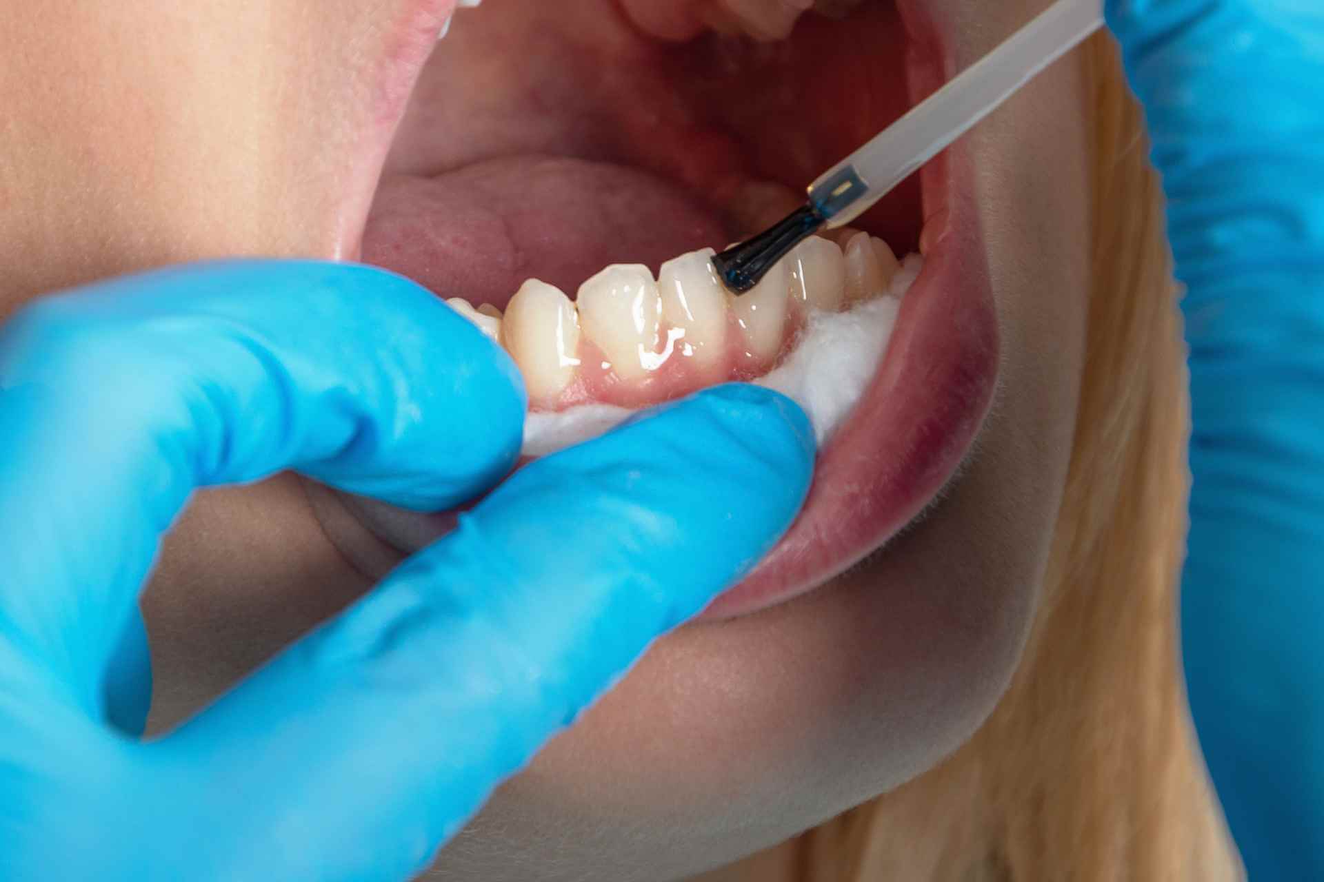 Perawatan pencegahan gigi berlubang fluoride varnish khusus anak di Dentistime