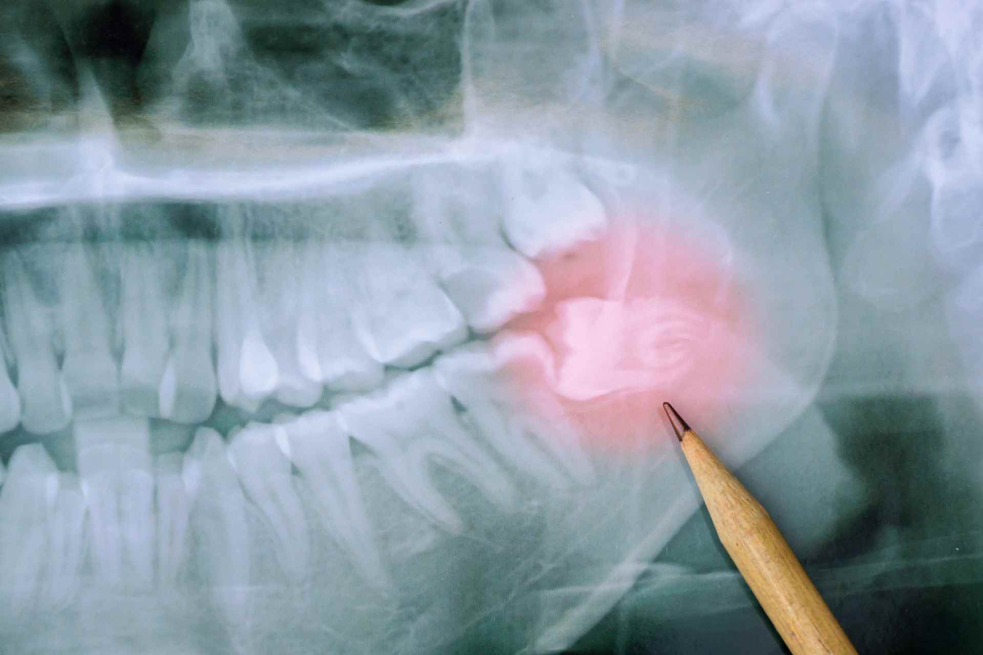 Tindakan operasi cabut gigi bungsu oleh dokter gigi spesialis bedah mulut di Dentistime