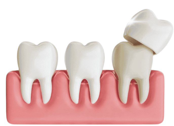 Pemasangan dental crown mahkota gigi tiruan berkualitas tinggi di Dentistime Pekayon dan Cikunir