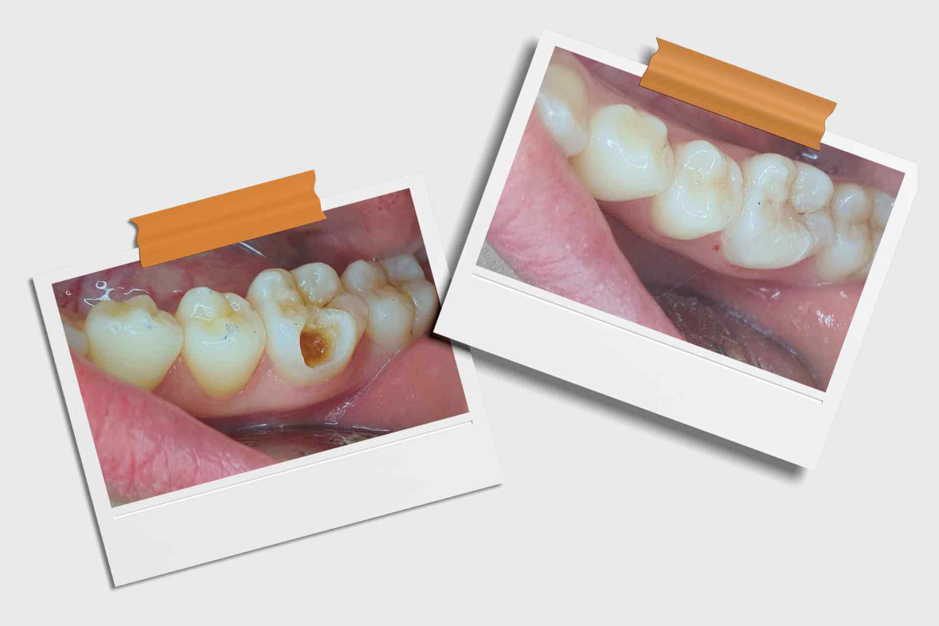 Hasil tindakan tambal gigi belakang yang nyaman dan rapi di Dentistime Pekayon dan Cikunir